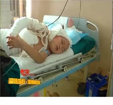 火灾无情人有情&nbsp;农家男孩严重烧伤亟待救治