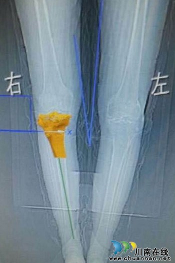川南首例3D打印膝关节置换术在泸州成功实施(图1) 川南首例3D打印膝关节置换术在泸州成功实施(图1)