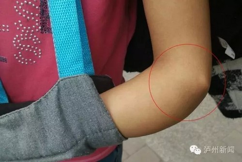 古蔺花季少女摔伤临残&nbsp;一老总赞助全部费用(图3)