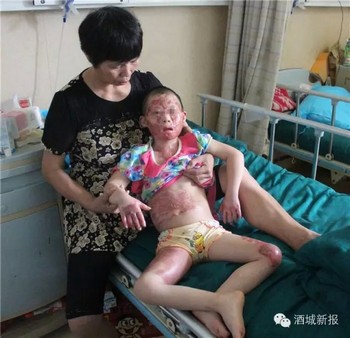 泸州弥陀8岁智残女童重度烧伤&nbsp;抚着记者脸说：我不怕(图3)