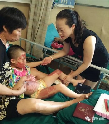 泸州弥陀8岁智残女童重度烧伤&nbsp;抚着记者脸说：我不怕(图2)