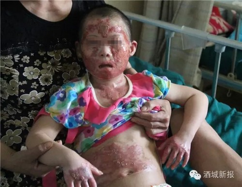 泸州弥陀8岁智残女童重度烧伤&nbsp;抚着记者脸说：我不怕(图1)