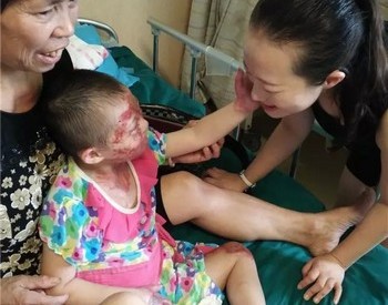 泸州弥陀8岁智残女童重度烧伤&nbsp;抚着记者脸说：我不怕