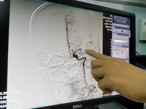 西南医科大学介入取栓术&nbsp;让偏瘫病人重新站起来(图1)