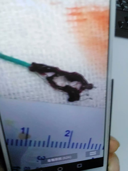 西南医科大学介入取栓术&nbsp;让偏瘫病人重新站起来(图2)