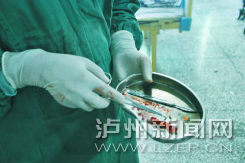 叙永男吃辣鸡面“用力过猛” 阑尾“吃脱”了(图1) 叙永男吃辣鸡面“用力过猛” 阑尾“吃脱”了(图1)