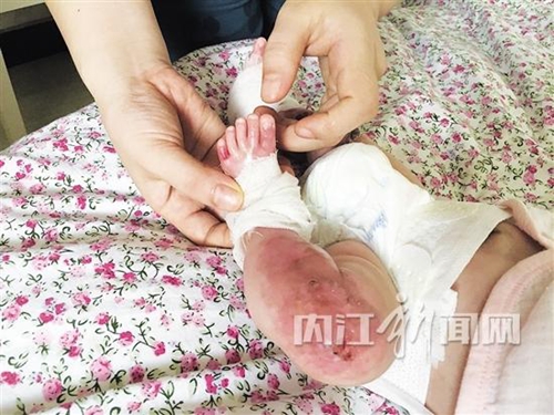 内江女喜得爱女却患怪病&nbsp;轻微摩擦就起水泡(图1)