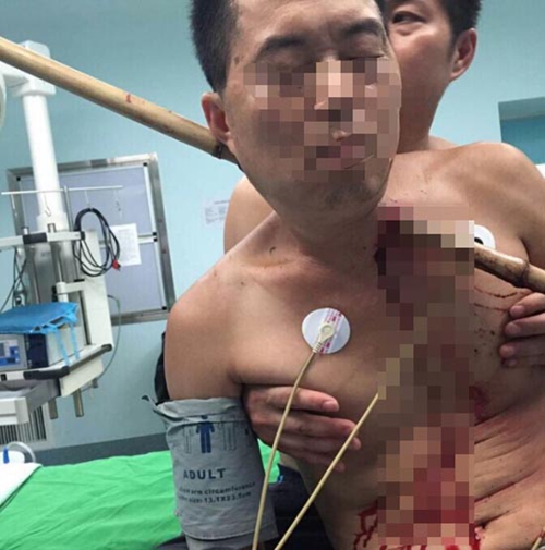 宜宾男被竹竿插穿颈部&nbsp;女护士跪地3小时扶竿(图1)