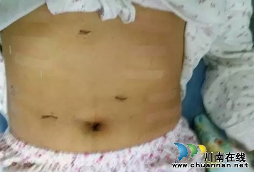 西南医大肝胆外科成功开展首例成人腹腔镜胆总管囊肿切除术(图2)