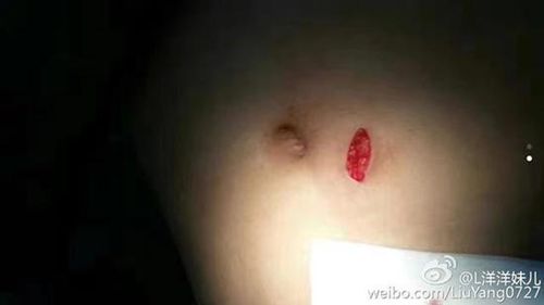 泸县医生深夜救治伤者被刺 凶手在逃同伴被抓(图1) 泸县医生深夜救治伤者被刺 凶手在逃同伴被抓(图1)