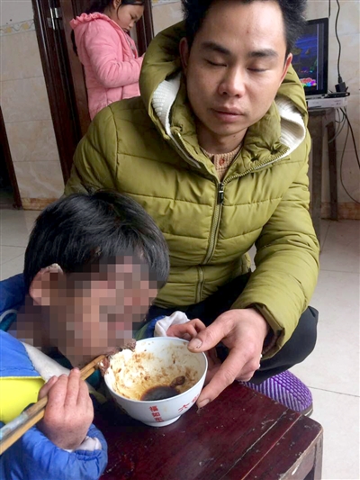 父母近亲结婚&nbsp;宜宾男童患绝症满脸长黑色异物(图1)