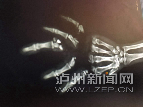 泸州：切割机切断右手&nbsp;6医生17小时接活断指