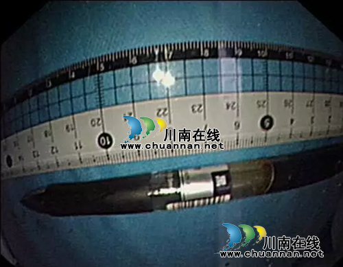 误吞15公分长异物 西南医大中医院45分钟取出(图1) 误吞15公分长异物 西南医大中医院45分钟取出(图1)