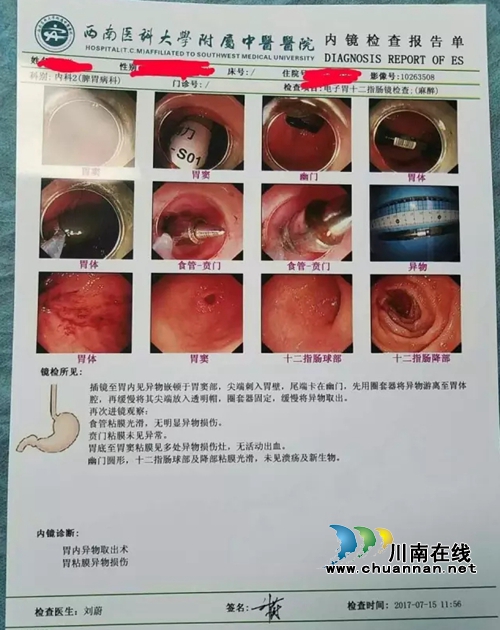 误吞15公分长异物 西南医大中医院45分钟取出(图2) 误吞15公分长异物 西南医大中医院45分钟取出(图2)