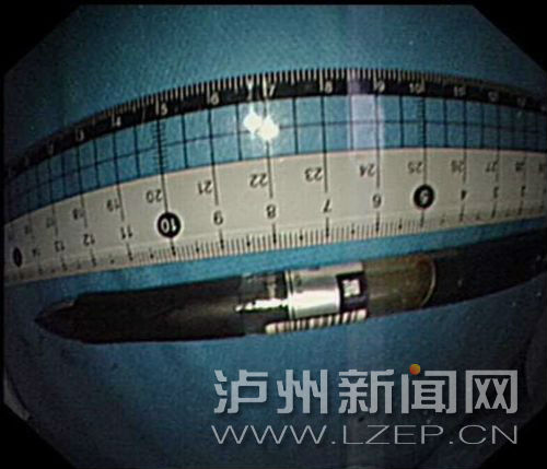 泸州男误吞15厘米长签字笔 医生花45分钟取出(图1) 泸州男误吞15厘米长签字笔 医生花45分钟取出(图1)