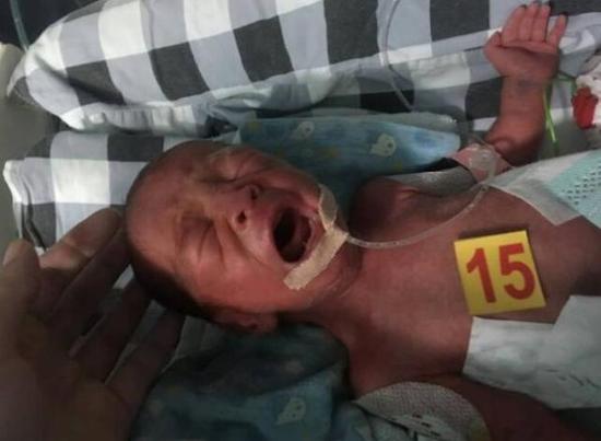 宜宾早产三胞胎加起来才7斤多 随时可能死亡(图3) 宜宾早产三胞胎加起来才7斤多 随时可能死亡(图3)