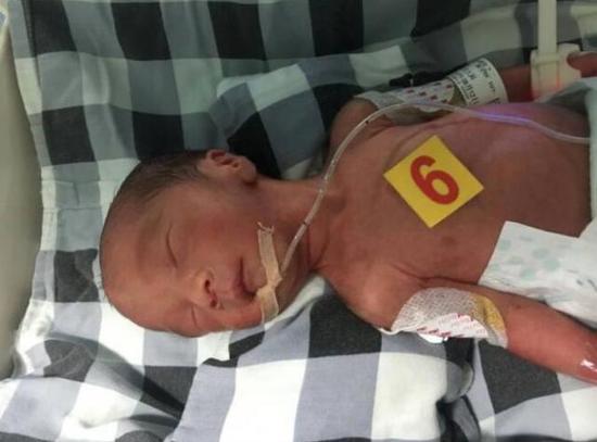 宜宾早产三胞胎加起来才7斤多 随时可能死亡(图2) 宜宾早产三胞胎加起来才7斤多 随时可能死亡(图2)