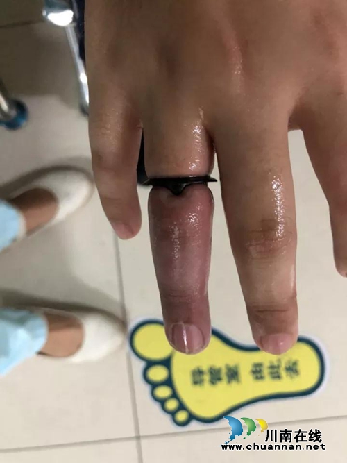 泸州12岁男孩钢圈套手指!10多分钟后终取出(图1) 泸州12岁男孩钢圈套手指!10多分钟后终取出(图1)