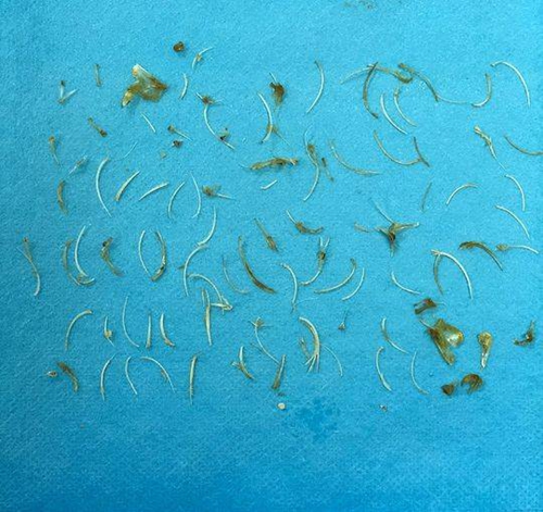 老人吃2碗小鲫鱼不吐刺&nbsp;100根刺扎直肠