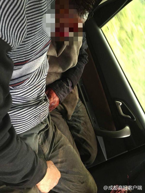 宜宾一村民上山寻中药 遭黑熊袭击被咬烂脸(图2) 宜宾一村民上山寻中药 遭黑熊袭击被咬烂脸(图2)
