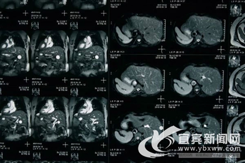 宜宾现“镜面人”&nbsp;五脏六腑全都反着长(图1)