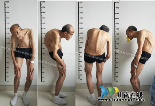 西南医大中医院施妙手&nbsp;大爷不到半年长35厘米(图1)