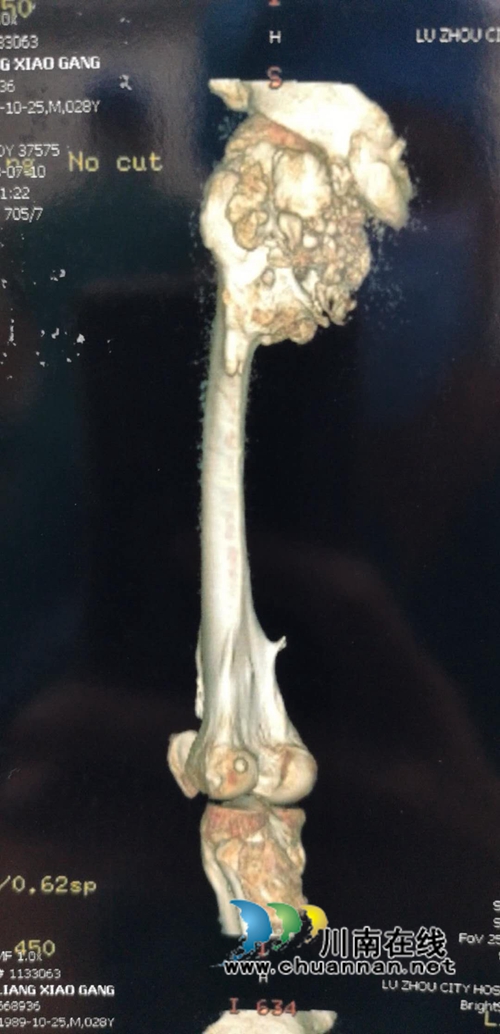 泸州市人医成功手术:避免了肢体切除(图4) 泸州市人医成功手术:避免了肢体切除(图4)