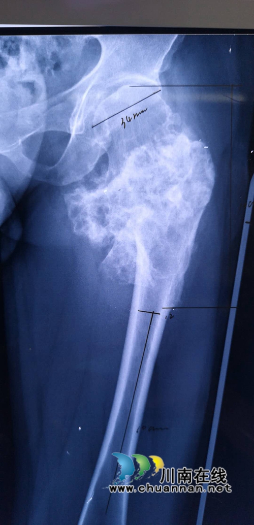 泸州市人医成功手术:避免了肢体切除(图3) 泸州市人医成功手术:避免了肢体切除(图3)