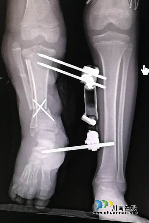 西南医大中医院“增高术”&nbsp;助女孩告别长短腿(图1)