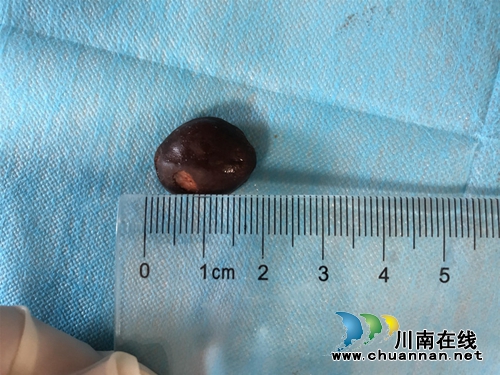 一颗枇杷核卡喉两个月，后果竟然……(图1)