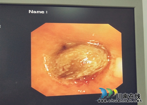 一颗枇杷核卡喉两个月，后果竟然……(图3)
