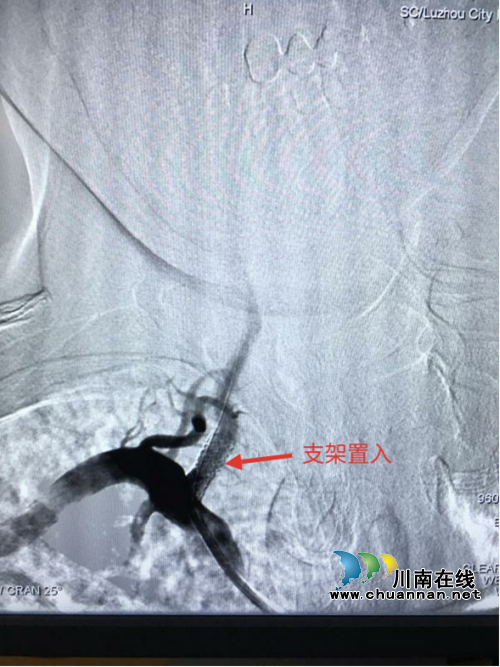 泸州市人民医院神经内科成功开展脑血管病介入治疗(图3)
