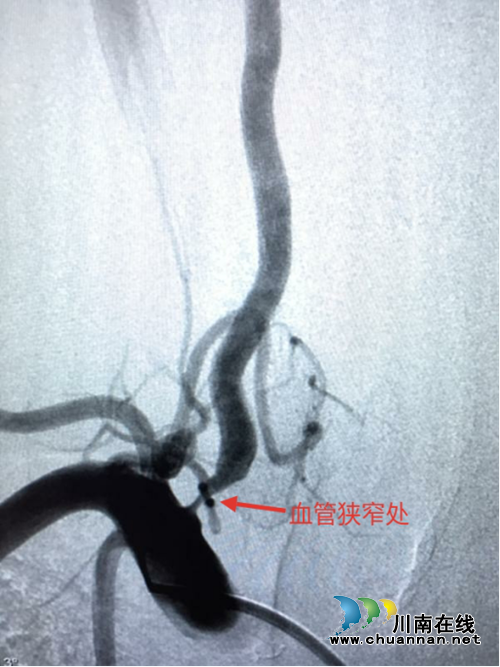 泸州市人民医院神经内科成功开展脑血管病介入治疗(图2)