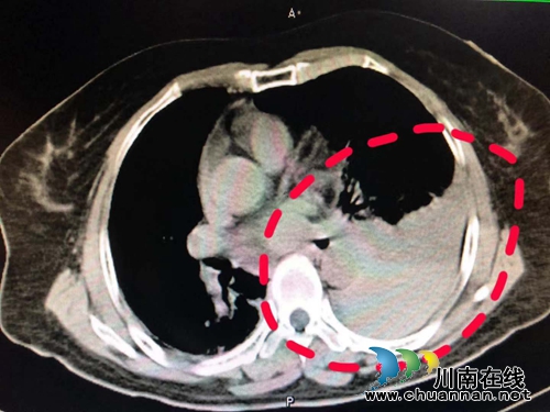 拇指粗的竹竿插进颈子，6旬老太竟自行拔出？(图2)