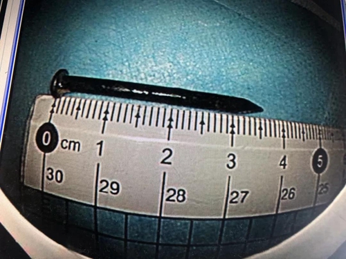 惊险！泸州男口含钉子干活&nbsp;钉子直接吃进肚里(图1)