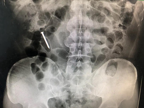 惊险！泸州男口含钉子干活&nbsp;钉子直接吃进肚里(图2)