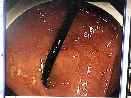 惊险！泸州男口含钉子干活&nbsp;钉子直接吃进肚里(图3)