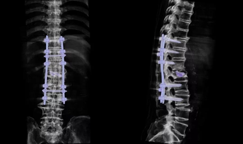 微创手术后竟要“开肚剖背”?看专家怎么做!(图4) 微创手术后竟要“开肚剖背”?看专家怎么做!(图4)