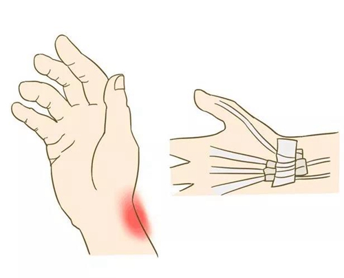 泸州女子手指突然不听使唤！竟是得了这种病？(图1)