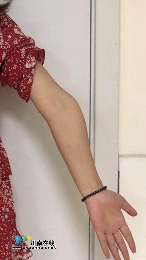 江阳新联会：为7名骨骼畸形残障人士手术成功(图1)