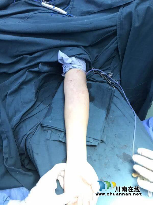 江阳新联会：为7名骨骼畸形残障人士手术成功(图2)