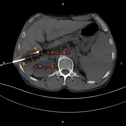 泸州：肝癌患者入院治疗&nbsp;2根针秒杀肿瘤细胞(图2)