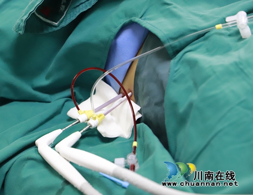 泸州：肝癌患者入院治疗&nbsp;2根针秒杀肿瘤细胞(图3)