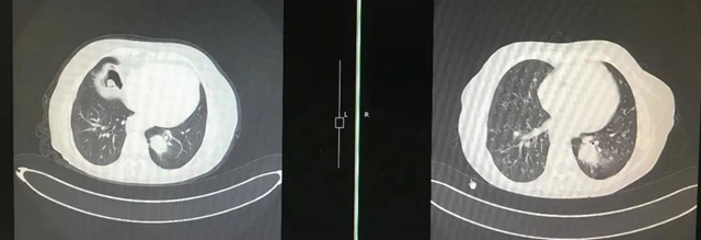【西南医大中医院•关注】疫情之下!肺癌晚期再次多处转移(图7) 【西南医大中医院•关注】疫情之下!肺癌晚期再次多处转移(图7)