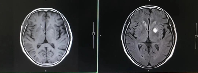 【西南医大中医院•关注】疫情之下!肺癌晚期再次多处转移(图8) 【西南医大中医院•关注】疫情之下!肺癌晚期再次多处转移(图8)