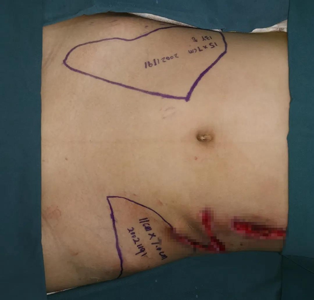 【围观】13岁男孩肚子上长出了一只手？(图7)