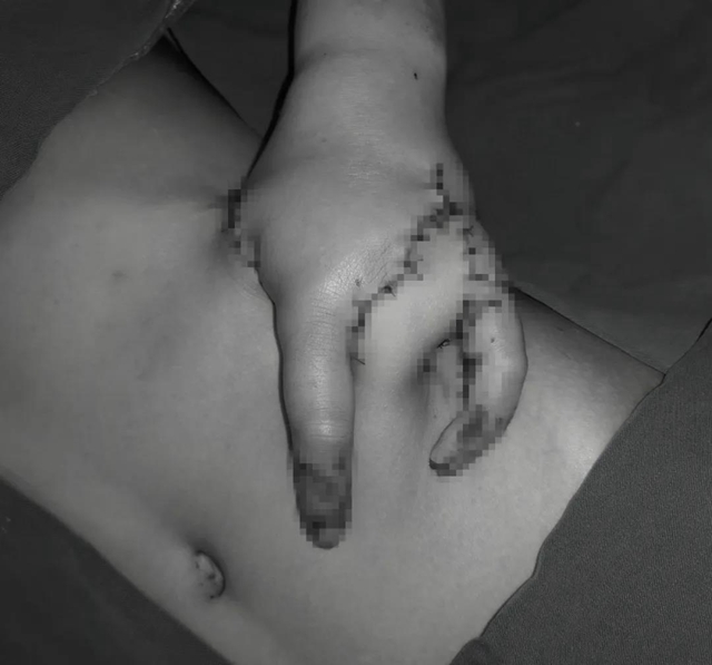 【围观】13岁男孩肚子上长出了一只手？(图8)