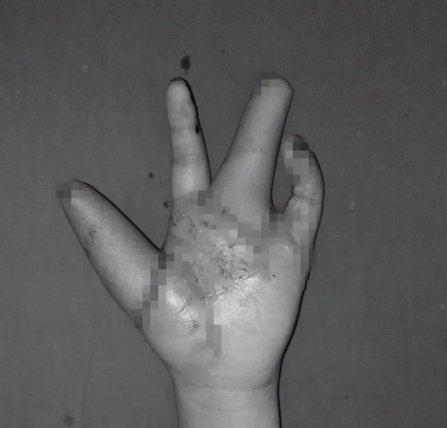 【围观】13岁男孩肚子上长出了一只手？(图9)