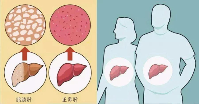 【关注】00后高中生也得脂肪肝？(图7)