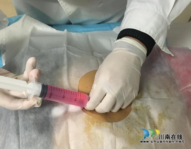 【神奇】屁股上jū几针，腰椎间盘突出治好了？(图4)